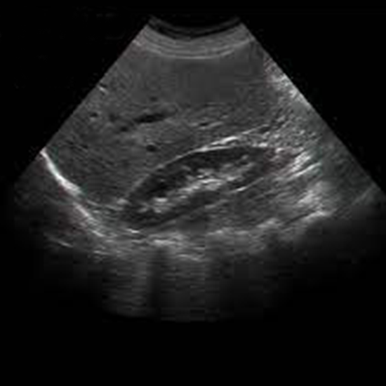 Ultrasound KUB and Prostate